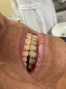 Projeto Resgatando sorrisos faz a entrega de mais dez próteses dentárias
